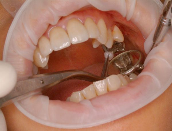 Na czym polega wyrywanie zęba 